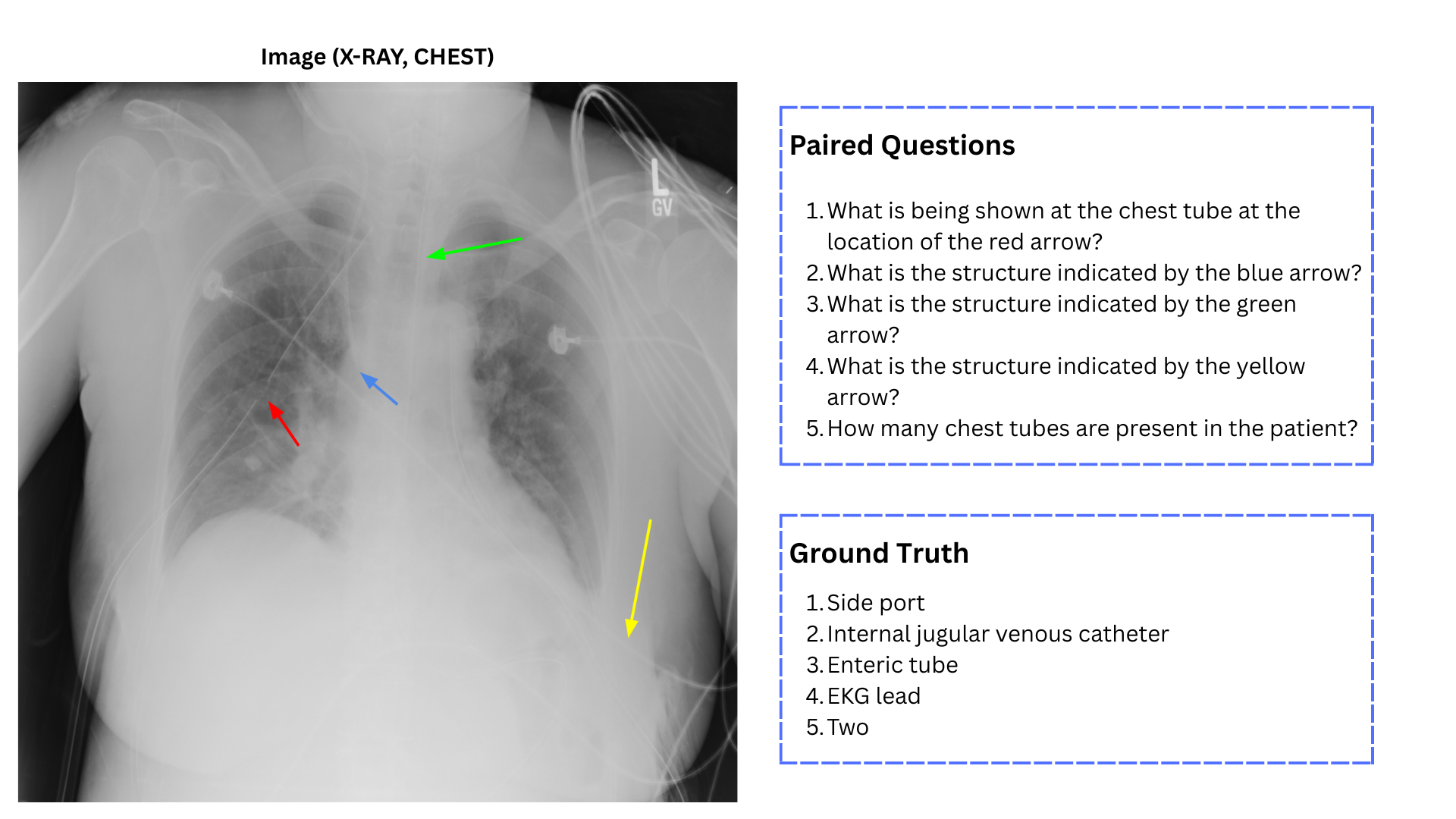 Representative SPARC-Rad benchmark instance: a chest radiograph paired with spatially grounded questions